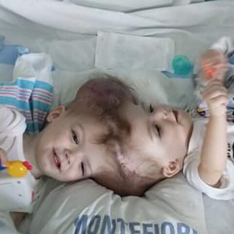 Illustratie bij: Heerlijke foto: siamese tweeling ziet elkaar voor het eerst na operatie