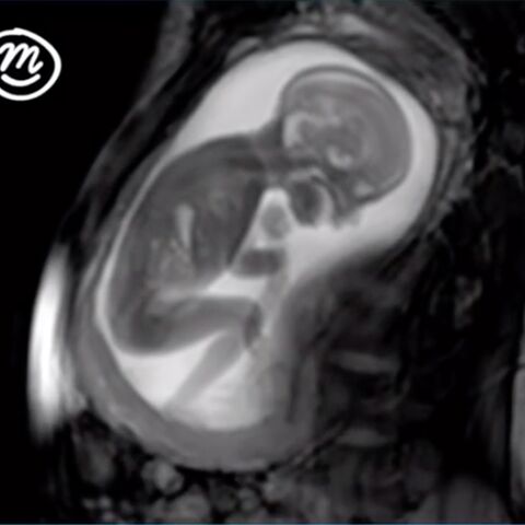 Illustratie bij: Deze MRI scan van een ongeboren baby is nog toffer dan een echo