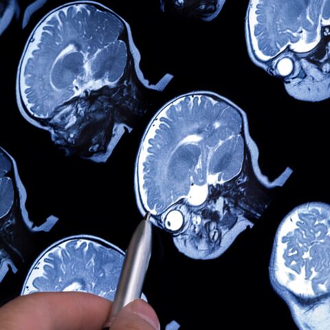 Illustratie bij: Autisme eerder te ontdekken door MRI: moeten we dat willen?