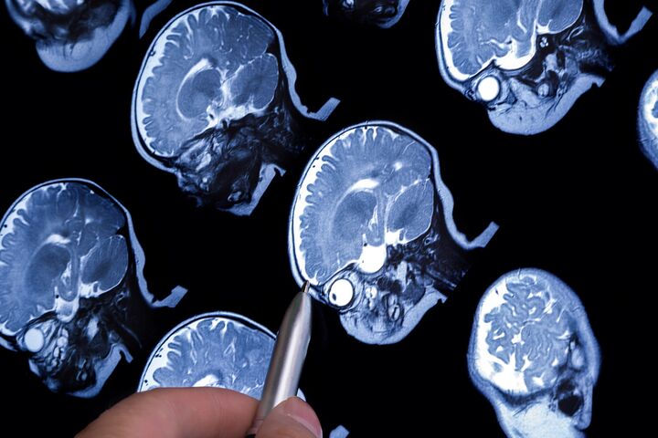Autisme eerder te ontdekken door MRI: moeten we dat willen?