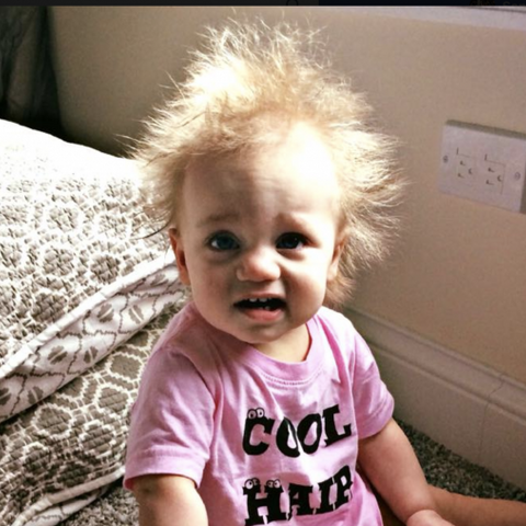 Illustratie bij: Je wist niet dat het bestaat: deze baby heeft ‘onkambaar haar syndroom’